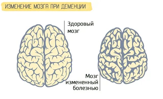 Мозг при деменции. Поражение мозга при деменции. головной мозг при деменции.
