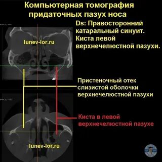 Кт онп
