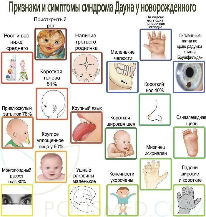 Почему рождается ребенок с синдромом дауна причины. Внешние проявления синдрома дауна. внешние признаки синдрома дауна у новорожденных. младенцы с синдромом дауна внешние признаки. характерные признаки проявления болезни синдрома дауна.