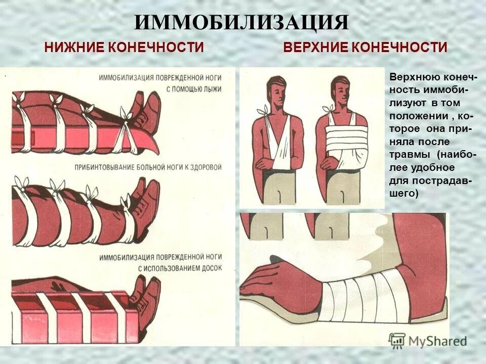 Шина при травме головы. Перелом конечностей иммобилизация. Иммобилизация конечности при переломе. Иммобилизация при переломе ноги. Иммобилизация при переломе верхних и нижних конечностей.