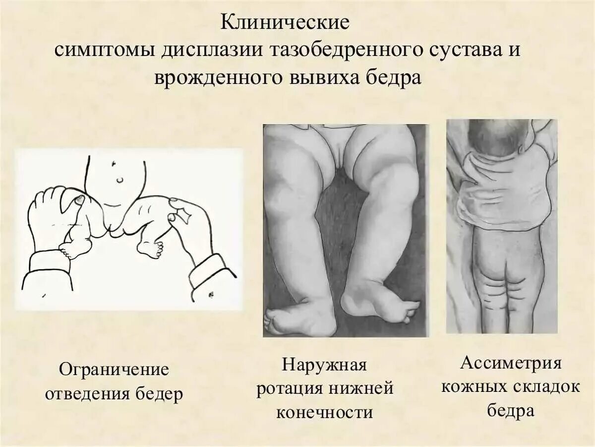 Дисплазия тазобедренных суставов у детей форум. Дисплазия тазобедренных суставов у ребенка 1 год. складки при дисплазии тазобедренных суставов у новорожденных. дисплазия тазобедренных суставов у новорожденных 1 годик. тазобедренная дисплазия у детей 1 год.