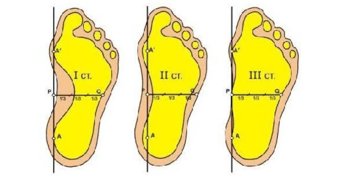 отпечаток стопы 3 степени плоскостопия. с какой степенью плоскостопия не берут в армию. служат в армии с плоскостопием. плоскостопие какие войска. плоскостопие 1 степени армия.
