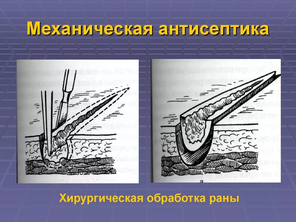 Методы обработки раны. Механическая антисептика в хирургии. механисечка антисептик. механическая антисептика раны. механическая и физическая антисептика в хирургии.