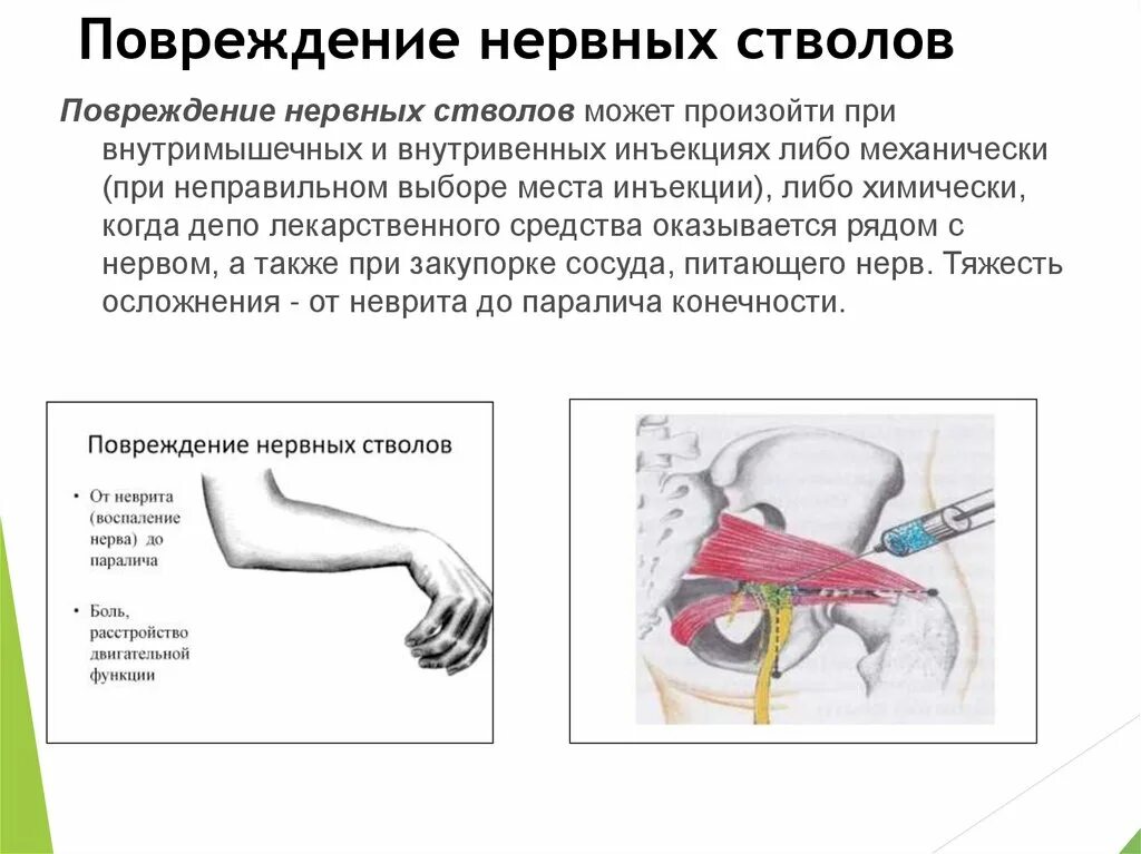 Повреждение нервных стволов при инъекции. Повреждение нервных стволов профилактика. Профилактика повреждения нервных стволов при инъекции.