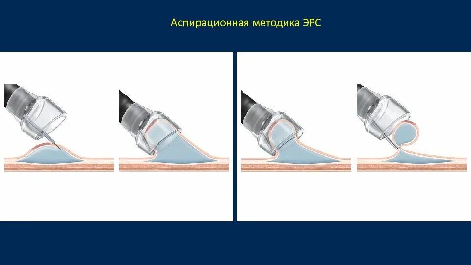 Эндоскопическая диссекция в подслизистом слое. Петлевая резекции слизистой. Диссекция в подслизистом слое. Подслизистая диссекция. Эндоскопическая подслизистая диссекция.