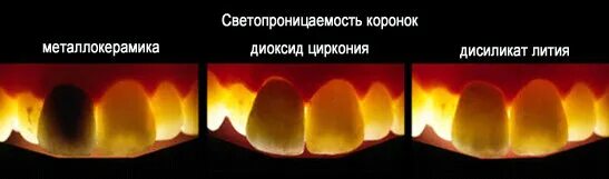 Что лучше циркониевая или металлокерамическая. Металлокерамическая коронка и диоксид циркония. металлокерамики или диоксида циркония. диоксид циркония коронки. металлокерамическая коронка из диоксида циркония.