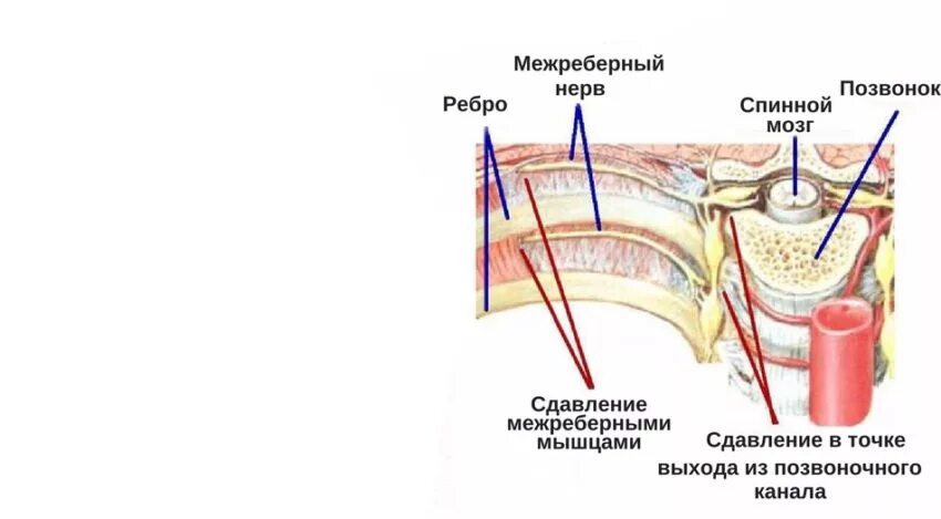 Межреберный нерв симптомы. Мкб левосторонняя межреберная невралгия. Межреберная невралгия, торакалгия.. Чем снять межреберную невралгию