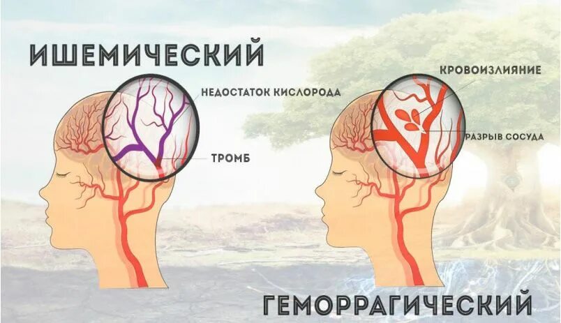 Инсульт левой артерии. Виды инсульта. Ишемический инсульт пульс. Какие есть виды инсульта. 2 Разновидности инсульта.