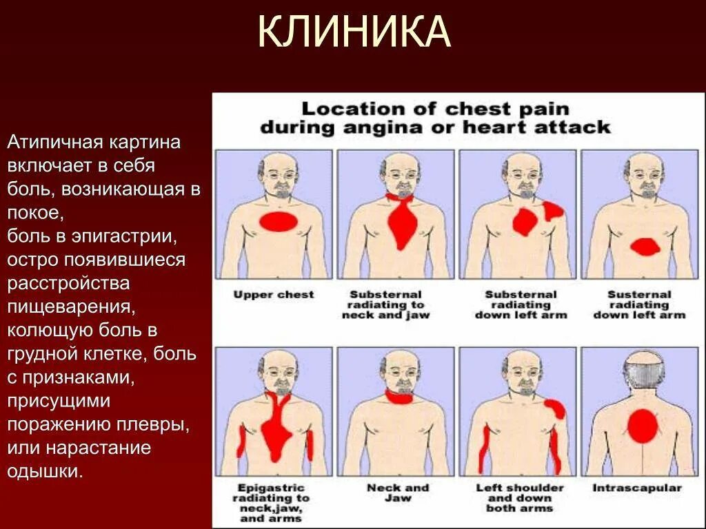 Ноющая боль в верхней части. Боли в центре под грудной клеткой спереди. Дольф в грудной клетке. Болит в левой части грудины.