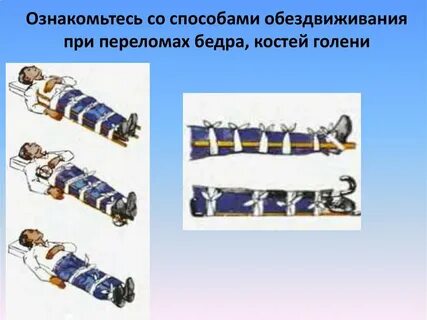 Помощь с предположительным переломом костей голени