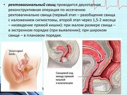 Свищ операция сколько длится