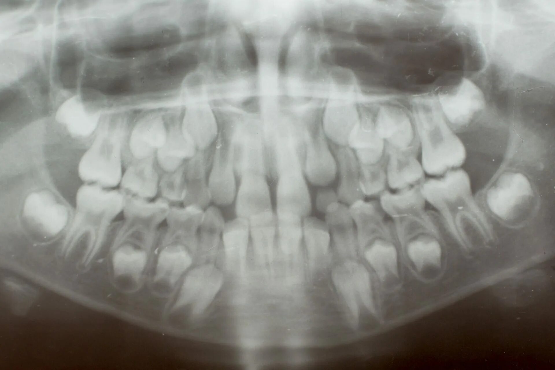 Рентген челюсти 2 ряда зубов. Молочный прикус рентген. Рентген челюсти с молочными зубами.
