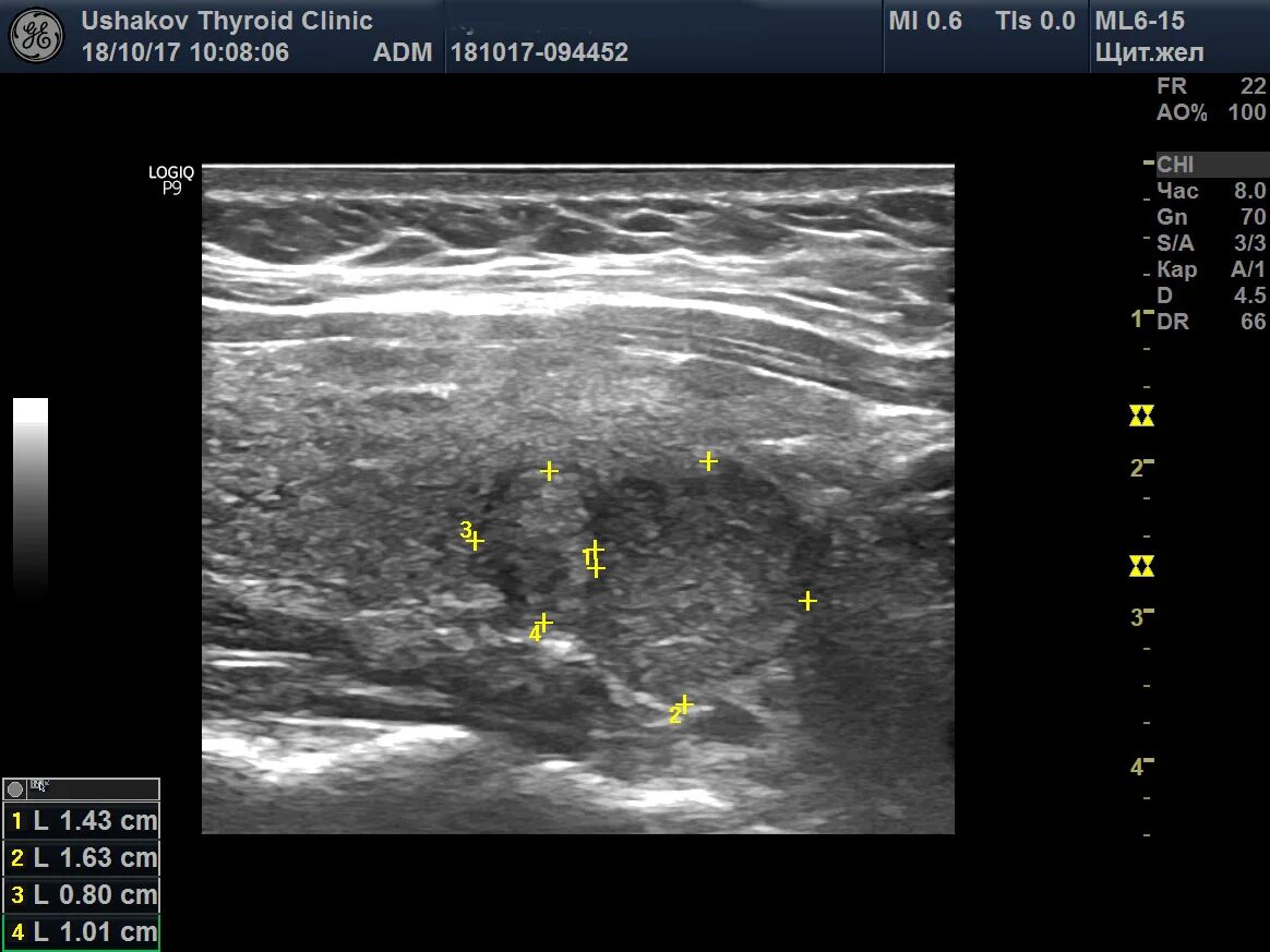 Щитовидная железа узел в левой доле. Склеротерапия щитовидной железы. Вертикальная ориентация узла щитовидной железы. Узлы в щитовидной железе. Узелел щитовидной железы.