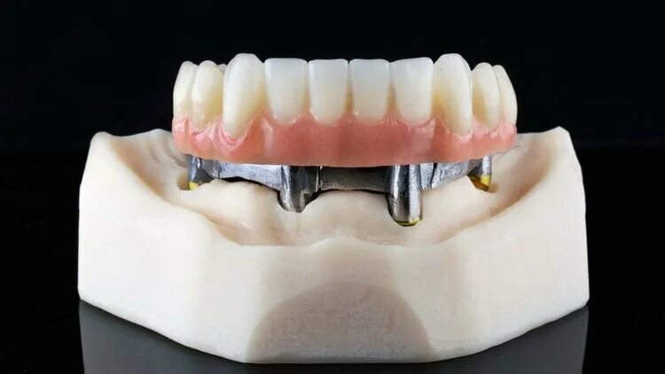 Балочная система фиксации бюгельных протезов. Балочный протез на 4. Условно-съемные балочные протезы. Съемный протез с балочной системой фиксации. Балочный протез на 4.