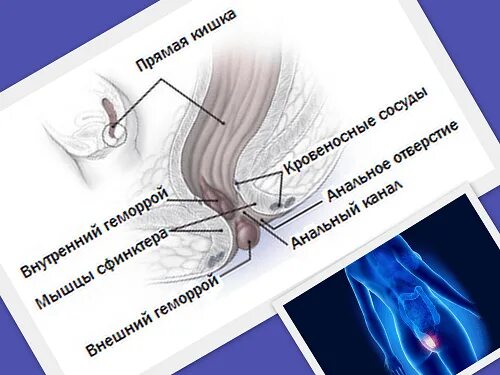 Геморрой причины возникновения и лечение у женщин. Внутренние геморроидальные узла располагаются.