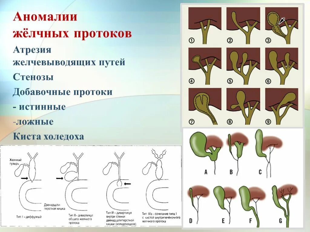 Желчный пузырь у новорожденного. Аномалии развития желчных протоков. Врожденные порок. Развития желчных протоков. Классификация атрезии желчных протоков. Аномалии развития внепеченочных желчных протоков.