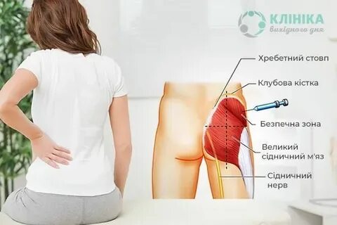 Блокада при защемлении седалищного