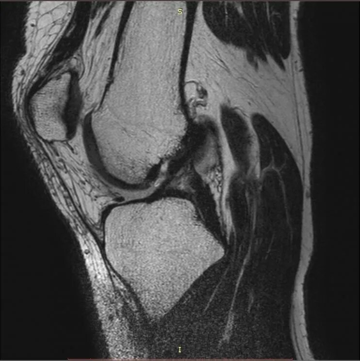 Мрт коленного сустава патологии. ПКС коленного сустава мрт. Снимок мрт колена крестообразная связка.