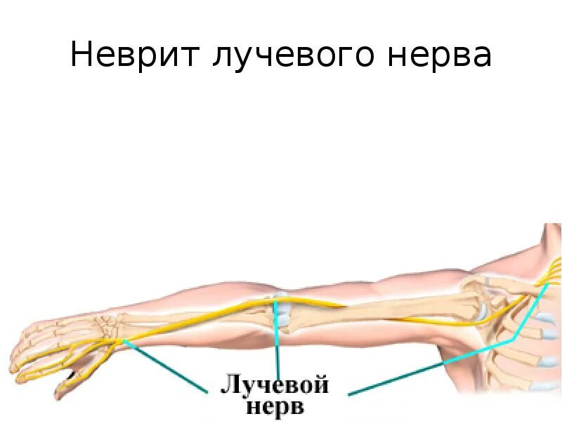 Посттравматический неврит. Фуникулярный миелоз мрт. Поражение общего малоберцового нерва симптомы. Посттравматический неврит. Посттравматический неврит.