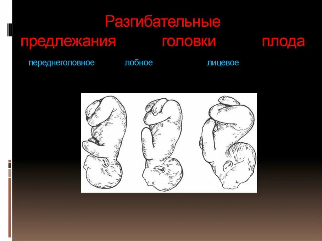 Предлежание головой. Переднеголовное предлежание. Лобное и лицевое предлежание плода. Разгибательное положение головки плода. Переднеголовное предлежание плода.