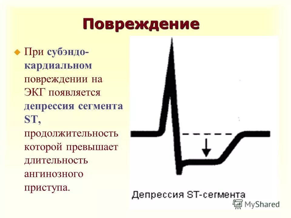 Депрессия сегмента st