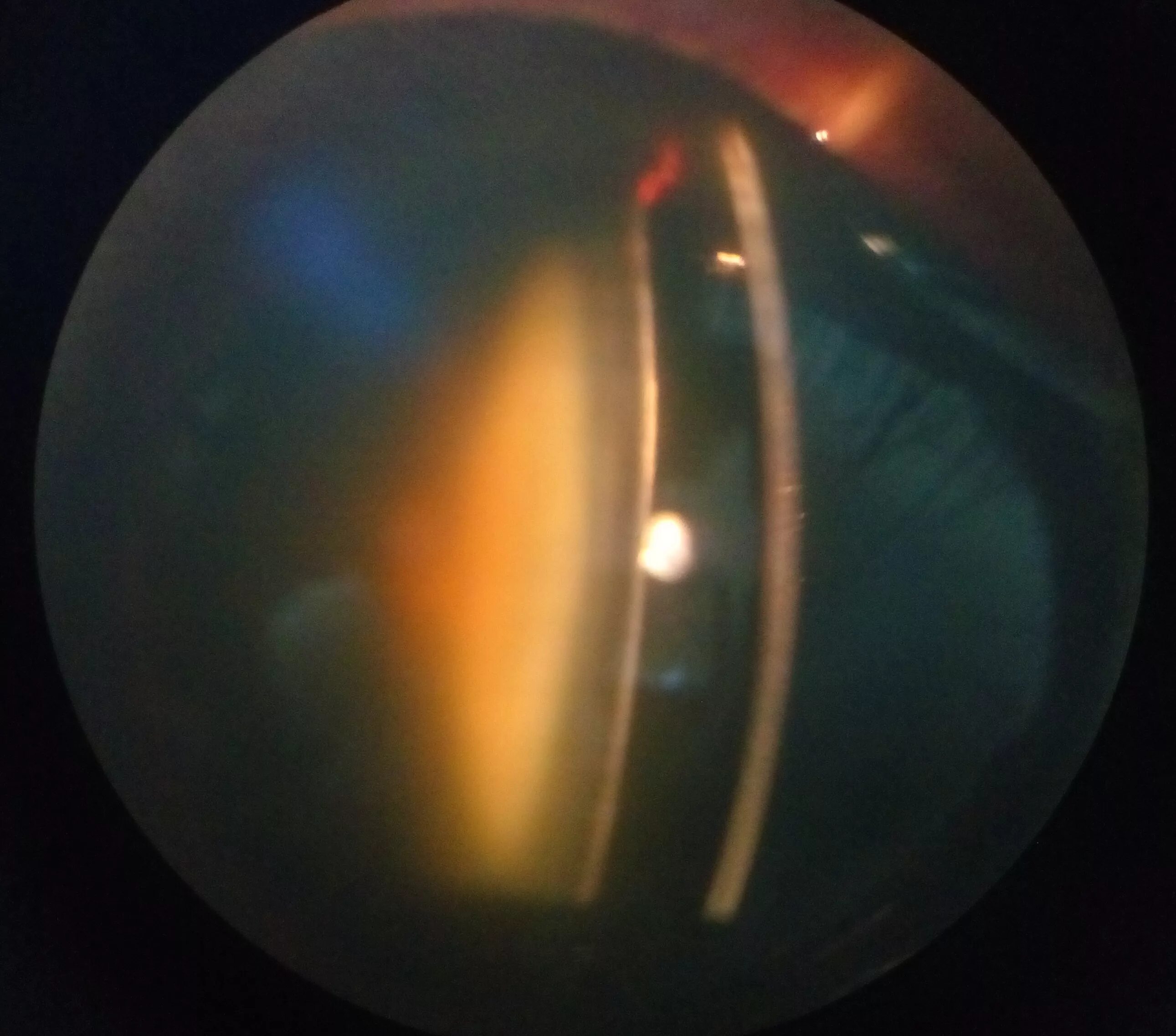 Ядерный склероз. Начальная заднекапсулярная катаракта. Веретенообразная врожденная катаракта. Морганиевая катаракта. Ядерный склероз.