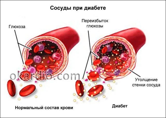 Классификация диабетической ангиопатии нижних конечностей. Диабетическая ретинопатия характеризуется. Макроангиопатия сосудов нижних конечностей. Диабетическая макроангиопатия сосудов нижних конечностей. Дифференциальный диагноз диабетической стопы.