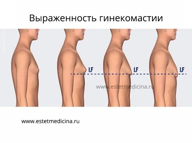 File:Gynecomastia-and-pseudogynecomastia-www.clicut.ir.jpg - Wikimedia Commons
