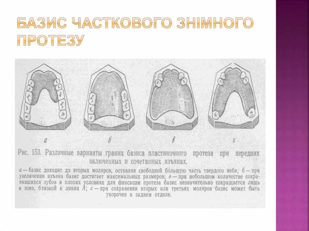 Границы полного съемного протеза верхнего. Граница базиса протеза на верхней челюсти. границы базиса протеза на нижней челюсти. границы базиса съемного протеза на верхней челюсти. границы базиса частичного съемного протеза на верхней челюсти.