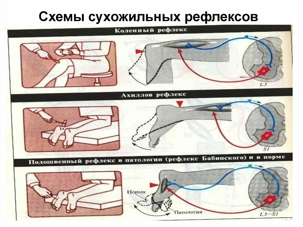 Рефлекс балл. Ахиллов рефлекс. Ахиллов сухожильный рефлекс. Ахиллов рефлекс дуга. Рефлекторные дуги проприоцептивных рефлексов ахиллова.