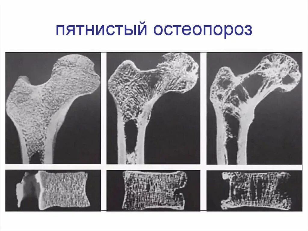 Остеопороз перелом рентген. Болезнь Горхема Стаута. Остеопороз костей рентген. Кость с остеопорозом рентген. В костях и т д