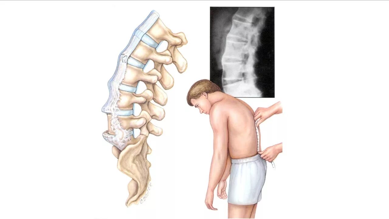 Операция смещение позвоночника. Анкилозирующий спондилоартрит болезнь Бехтерева. Анкилозирующий спондилоартрит шейного отдела рентген. Спондилёз поясничного отдела позвоночника что это такое. Спондилез l3-s1.