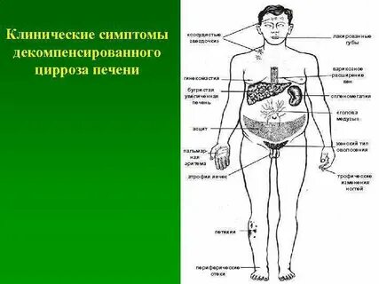 Что болит при циррозе