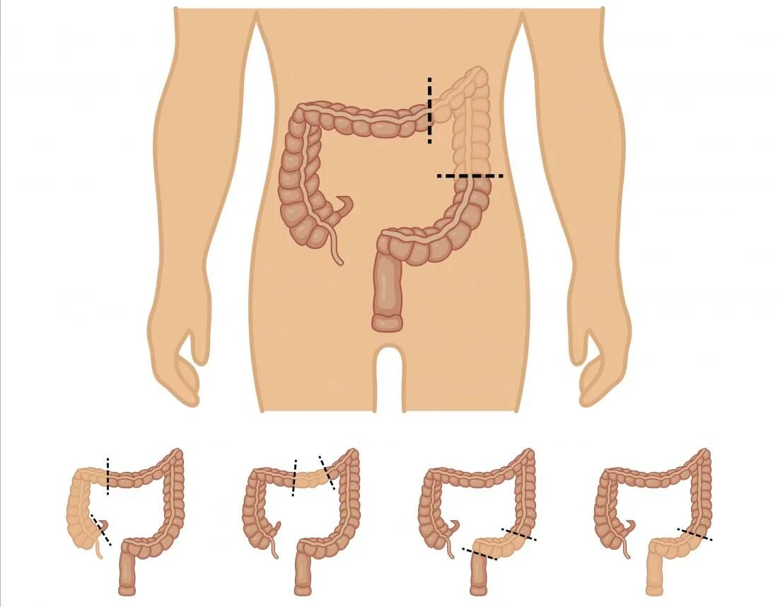 Субтотальная колэктомия. Субтотальная колэктомия субтотальная колэктомия. Колэктомия это