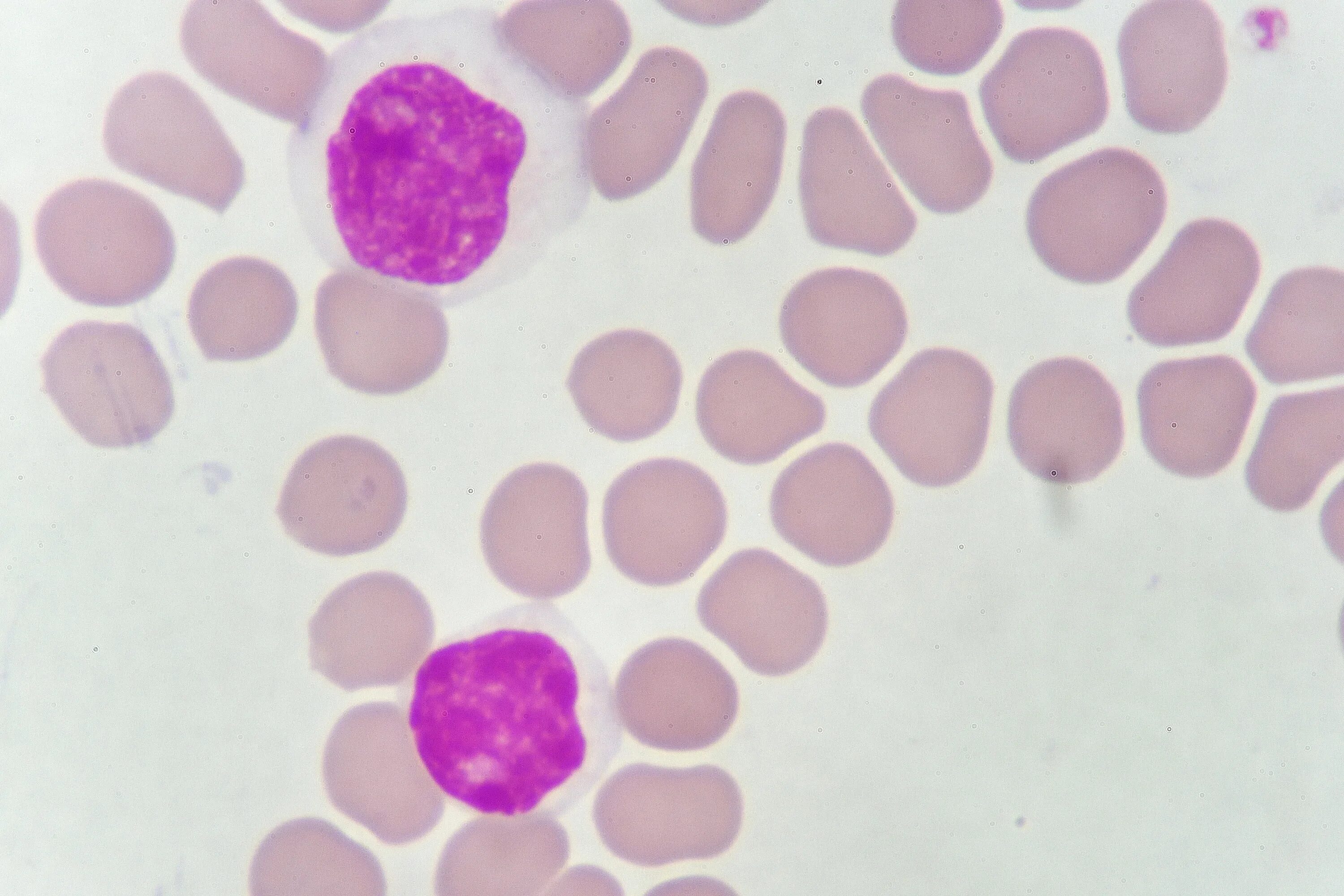 Мазок крови при выявлении патологии что это. Хронический лимфолейкоз микроскопия. Хронический лимфолейкоз мазок крови. Микроскопия мазков крови.