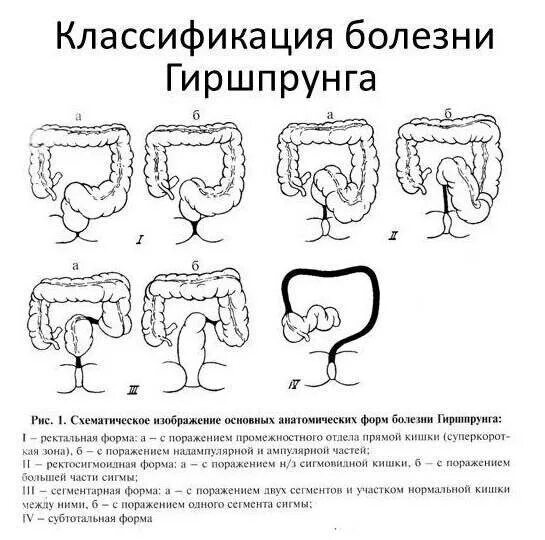 Ректальный заболевании. Анатомические формы болезни Гиршпрунга. Схема патогенеза болезни Гиршпрунга. Болезнь Гиршпрунга патогенез. Анатомическая классификация болезни Гиршпрунга.