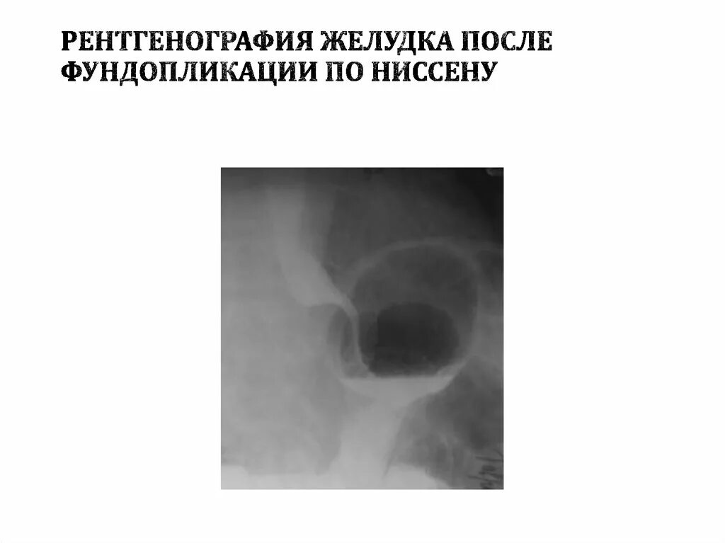 Рентгеноконтрастное исследование желудка. Рентген желудка что это. Рентгеноанатомия 12 перстной кишки. Рентген желудка что это. Рентгеноскопия желудка с барием язва желудка.