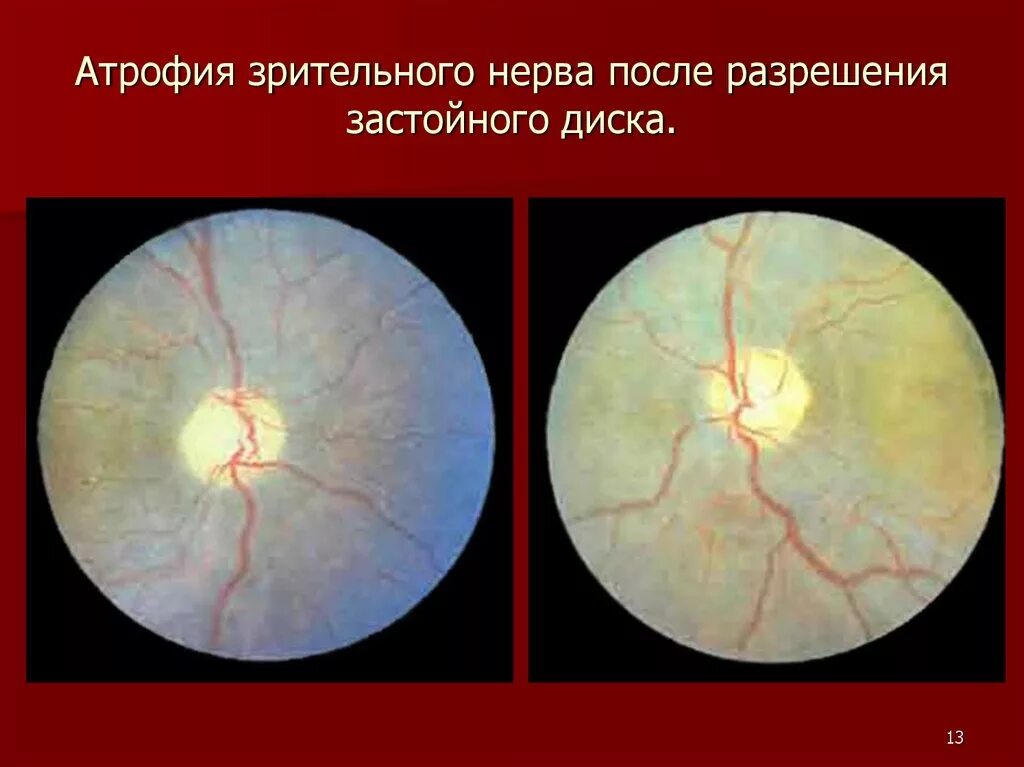 Атрофия зрительного нерва у детей. Атрофия зрительного нерва Лебера периметрия. Вторичная постзастойная атрофия зрительного нерва. Атрофия зрительного нерва Лебера генетика.