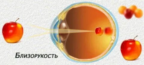 Миопия картинки