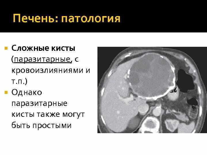 Паразитарная киста печени. Эхинококковая киста печени кт. Эхинококковая киста печени мрт. Кисты печени кт эхинококкоз. Паразитарные кисты печени кт.