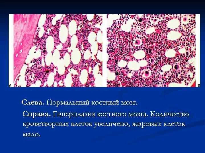 Жировое изменение костного мозга. Красный костный мозг гистология. гиперплазия костного мозга. гиперплазия красного костного мозга. клетки костного мозга.