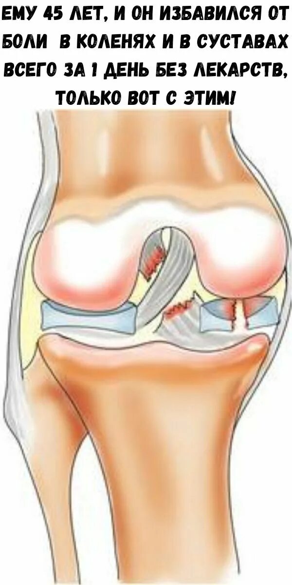 Болит ли мениск. Мениск коленного сустава жидкость. Разрыв мениска симптомы. Связки мениска коленного сустава. Строение колена мениск.