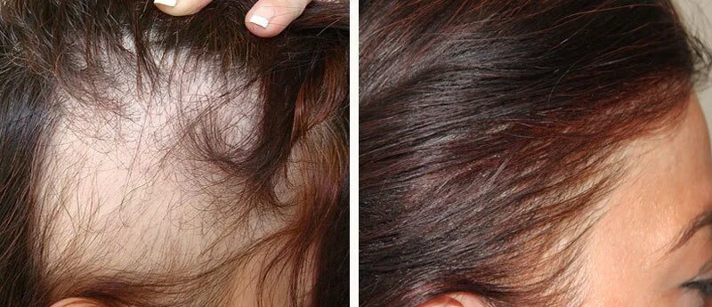 Мезотерапия волос до и после. Мезотерапия кожи головы до и после. Мезотерапия волосистой части головы. Мезотерапия волосистой части головы до и после. Выпадают волосы после операции