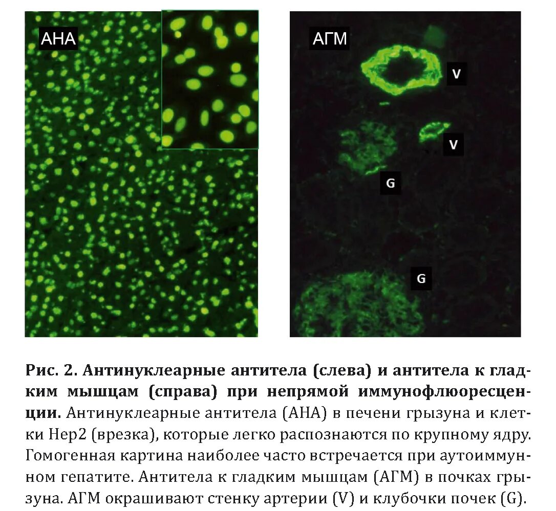 антинуклеарных антител норма. антинуклеарные антитела при скв. антинуклеарные антитела скрининг что это. антикугулярные антитела. антинуклеарный анализ крови расшифровка.
