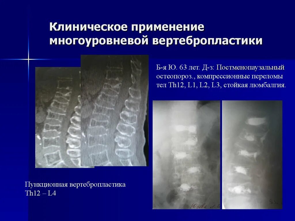 Компрессионный перелом позвоночника th11-l1. Компрессионный перелом позвоночника th12 l2. Компрессионный перелом th12 консолидирующийся. Компрессионный перелом остеопороз.