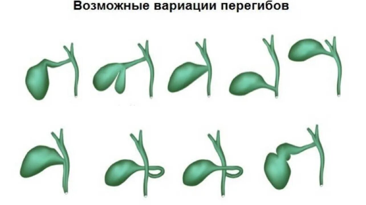 Желчный пузырь у новорожденного. Форма желчного пузыря с перегибом. Желчный пузырь грушевидной формы с перегибом. Загиб дна желчного пузыря. Перегиб желчного пузыря в средней трети.