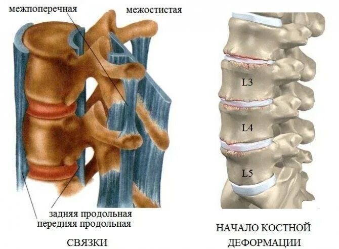 Как лечить спондилез поясничного отдела. L1-l4 деформирующий спондилез. спондилёз пояснично-крестцового отдела l1 l2. деформирующий спондилез l2 l5. спондилез l5-s1.