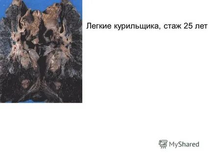 Курил 20 лет