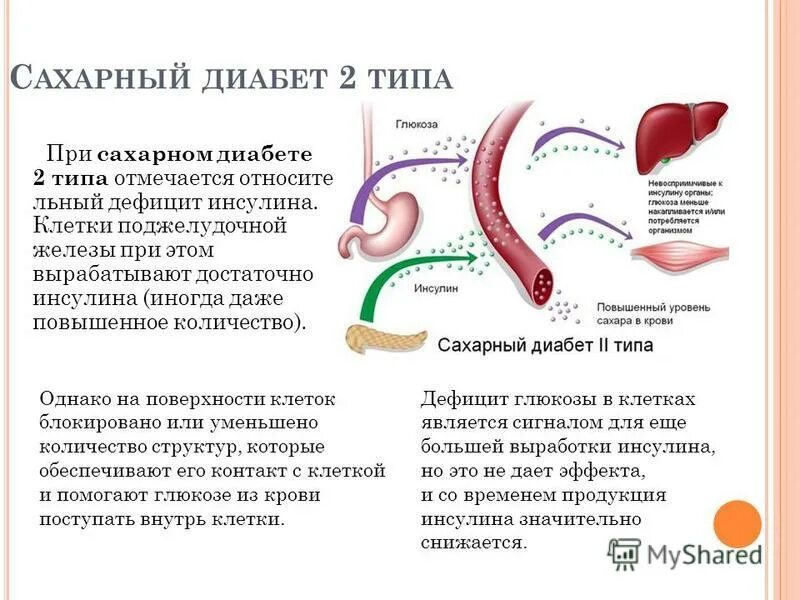 Поджелудочная железа при сахарном диабете 1 типа. Сахарный диабет поджелудочная железа. панкреатический сахарный диабет.