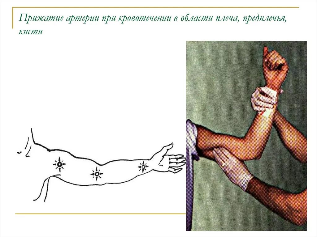 Прижатие плечевой артерии при кровотечении. Артериальное кровотечение средней трети предплечья. Пальцевое прижатие лучеврй артерии. Пальцевое прижатие плесевойартерии.